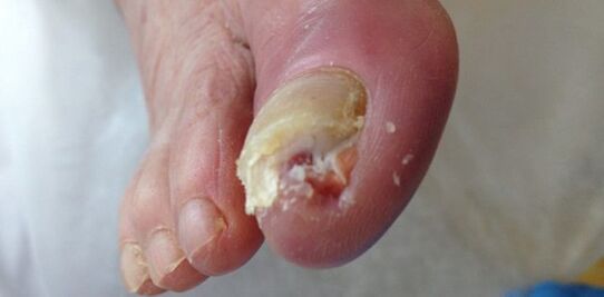 Zbiornik i źródło grzybów dermatofitycznych jest chory